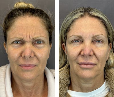 Dermal Fillers Before & After Gallery - Patient 146416181 - Image 6