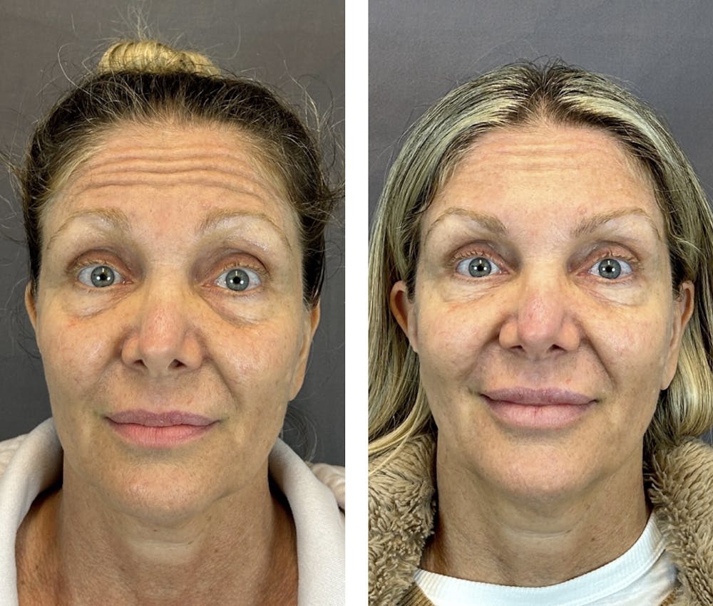 BOTOX Before & After Gallery - Patient 146416182 - Image 7
