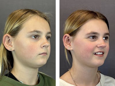 Ear Surgery Before & After Gallery - Patient 146416185 - Image 2