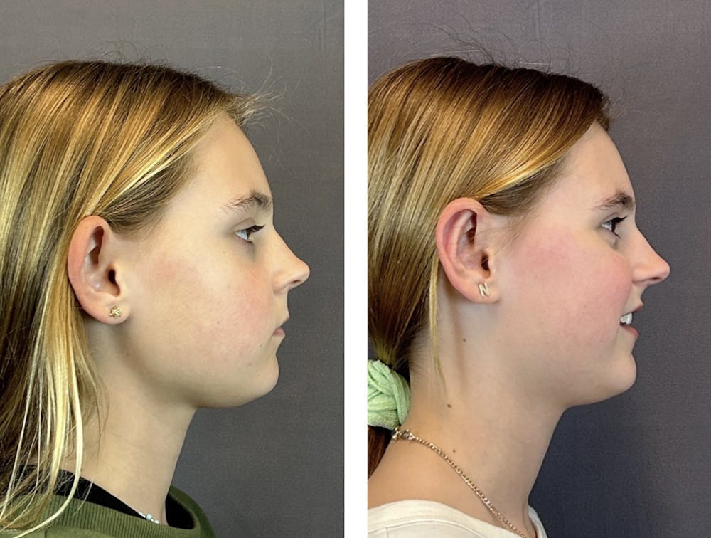 Ear Surgery Before & After Gallery - Patient 146416185 - Image 3