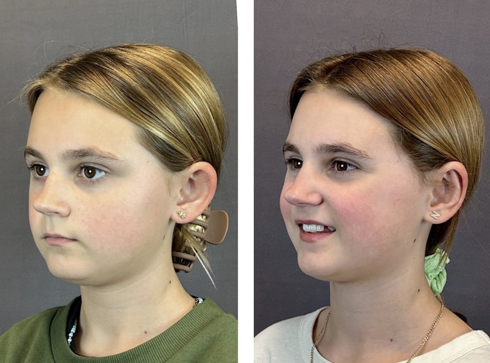 Ear Surgery Before & After Gallery - Patient 146416185 - Image 4