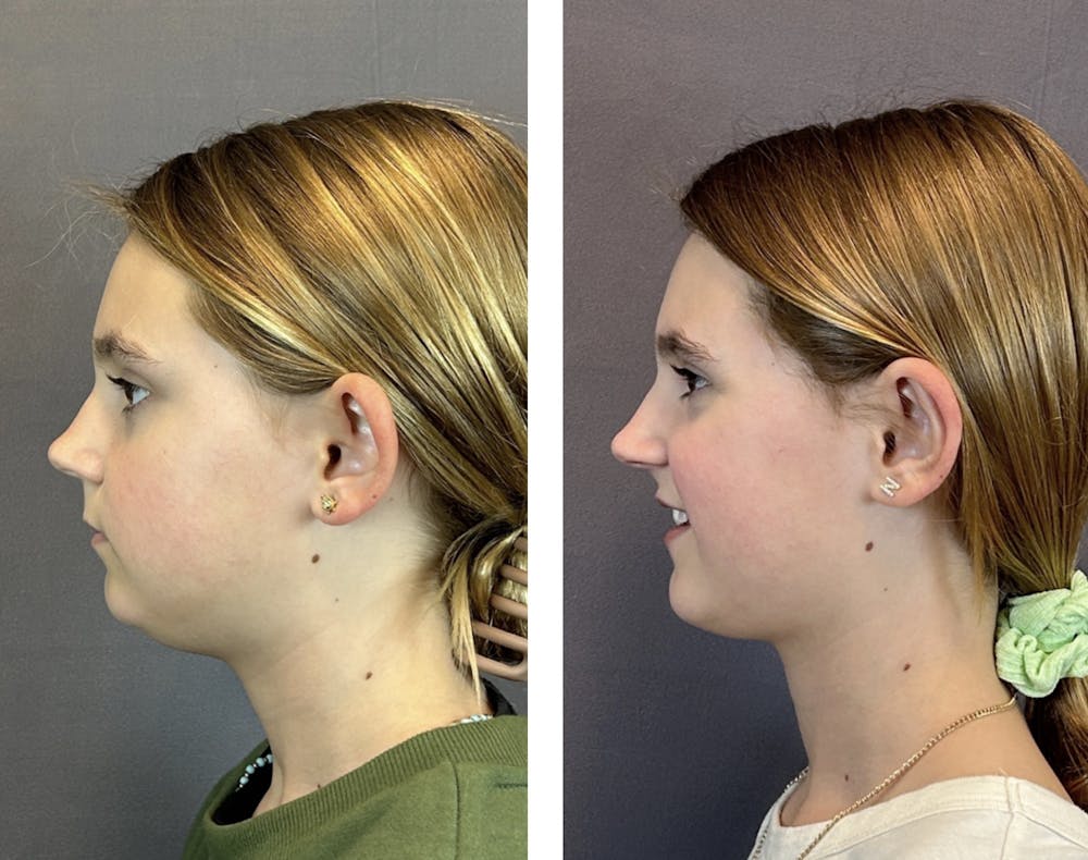 Ear Surgery Before & After Gallery - Patient 146416185 - Image 5
