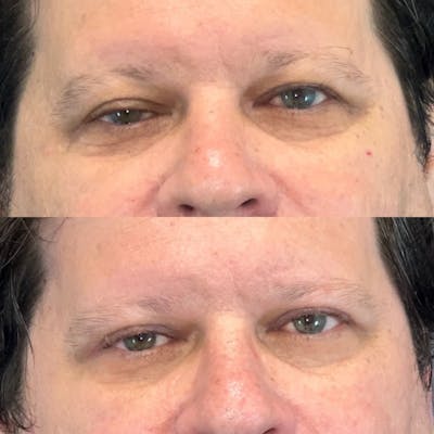 Ptosis Before & After Gallery - Patient 146464823 - Image 1