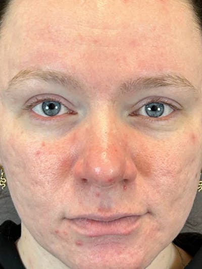 Forma Plus Skin Tightening Before & After Gallery - Patient 146622226 - Image 2