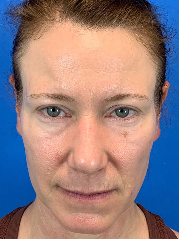 Forma Plus Skin Tightening Before & After Gallery - Patient 146622232 - Image 1