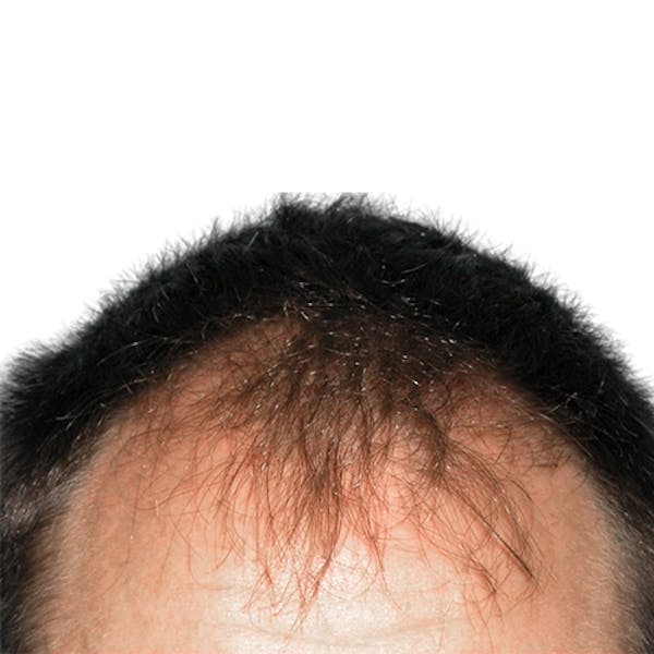 Hair Restoration  Before & After Gallery - Patient 147693826 - Image 1