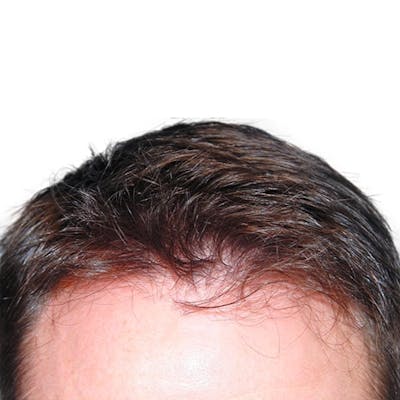 Hair Restoration  Before & After Gallery - Patient 147693826 - Image 2