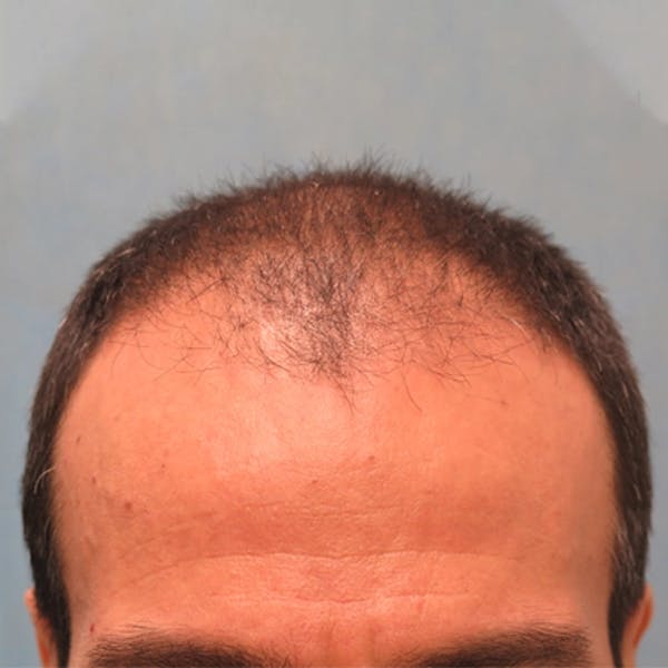 Hair Restoration  Before & After Gallery - Patient 147693827 - Image 1