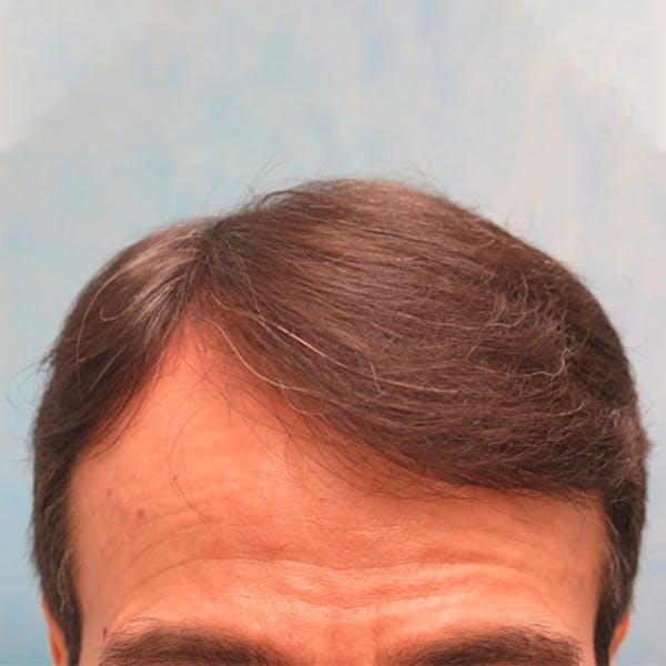 Hair Restoration  Before & After Gallery - Patient 147693827 - Image 2