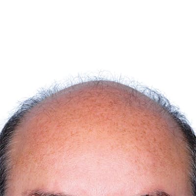 Hair Restoration  Before & After Gallery - Patient 147693828 - Image 1