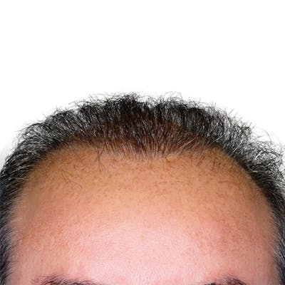 Hair Restoration  Before & After Gallery - Patient 147693828 - Image 2