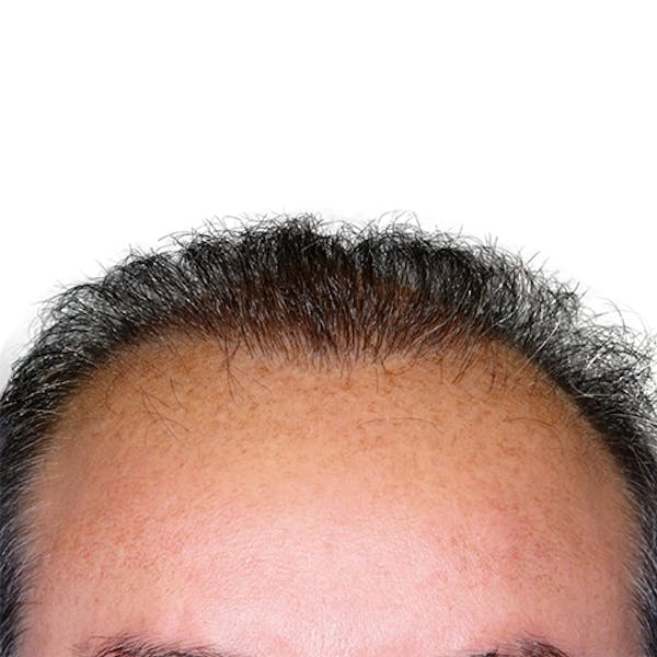 Hair Restoration  Before & After Gallery - Patient 147693828 - Image 2