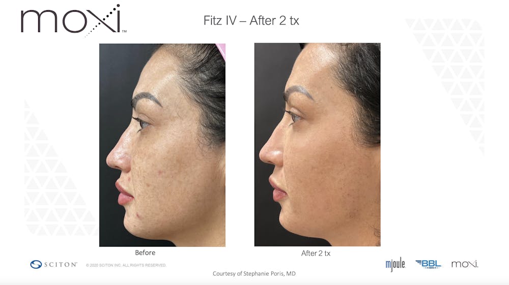 Sciton Moxi Laser Before & After Gallery - Patient 147776130 - Image 1