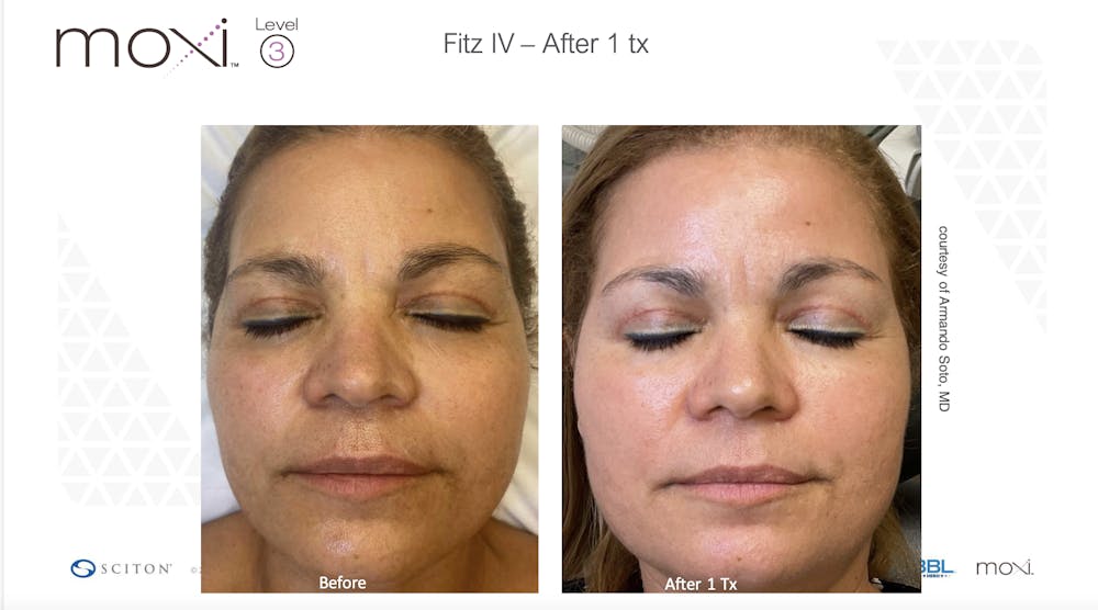 Sciton Moxi Laser Before & After Gallery - Patient 147776131 - Image 1