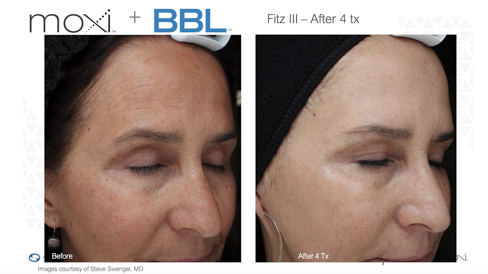 Sciton Moxi Laser Before & After Gallery - Patient 147776132 - Image 1