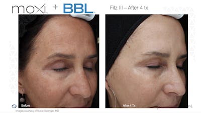 Sciton Moxi Laser Before & After Gallery - Patient 147776132 - Image 1