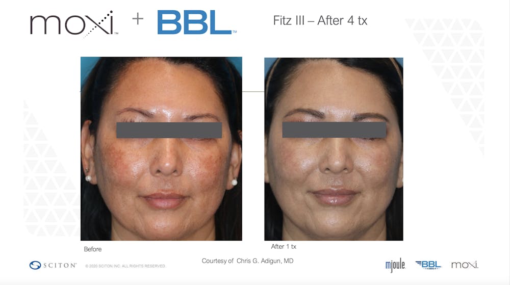 Sciton Moxi Laser Before & After Gallery - Patient 147776133 - Image 1