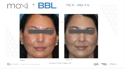 Sciton Moxi Laser Before & After Gallery - Patient 147776133 - Image 1