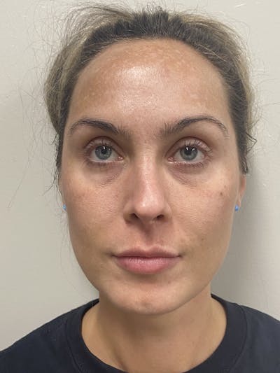 Sciton Moxi Laser Before & After Gallery - Patient 147776145 - Image 1