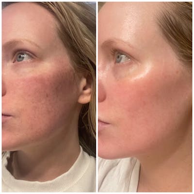 Sciton Moxi Laser Before & After Gallery - Patient 147776146 - Image 1
