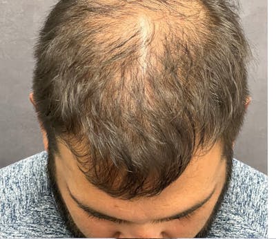 Hair Restoration  Before & After Gallery - Patient 148035812 - Image 1