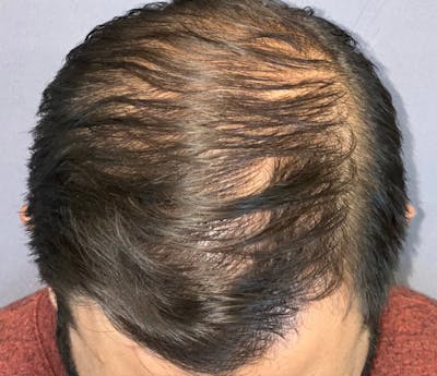 Hair Restoration  Before & After Gallery - Patient 148035812 - Image 2