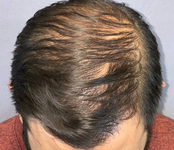 Hair Restoration  Before & After Gallery - Patient 148035812 - Image 2