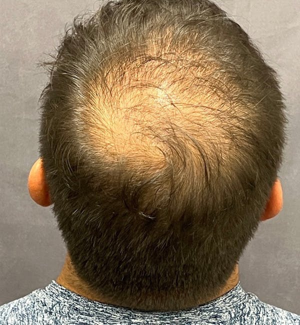 Hair Restoration  Before & After Gallery - Patient 148035812 - Image 3