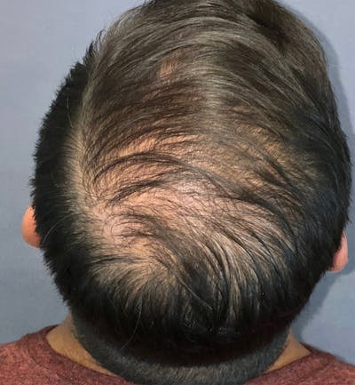 Hair Restoration  Before & After Gallery - Patient 148035812 - Image 4