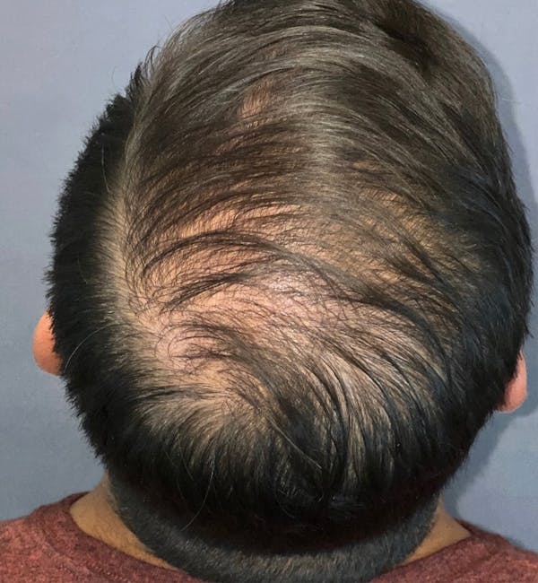 Hair Restoration  Before & After Gallery - Patient 148035812 - Image 4