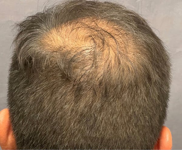 Hair Restoration  Before & After Gallery - Patient 148035812 - Image 5