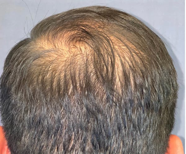 Hair Restoration  Before & After Gallery - Patient 148035812 - Image 6