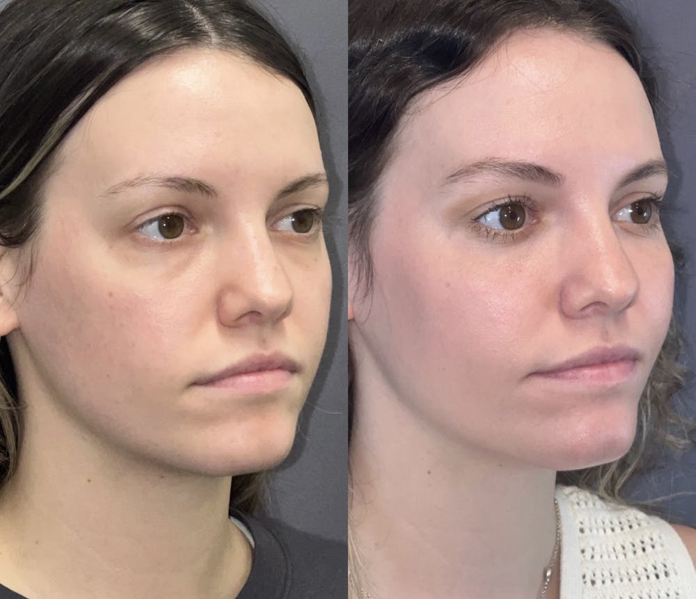 Sciton Halo Before & After Gallery - Patient 148217609 - Image 3