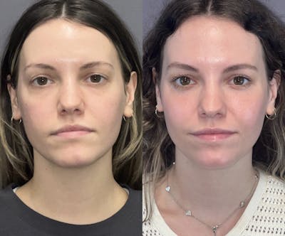 Laser Resurfacing Before & After Gallery - Patient 148217608 - Image 1