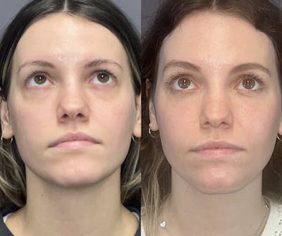 Laser Resurfacing Before & After Gallery - Patient 148217608 - Image 2