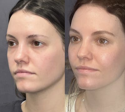Laser Resurfacing Before & After Gallery - Patient 148217608 - Image 4