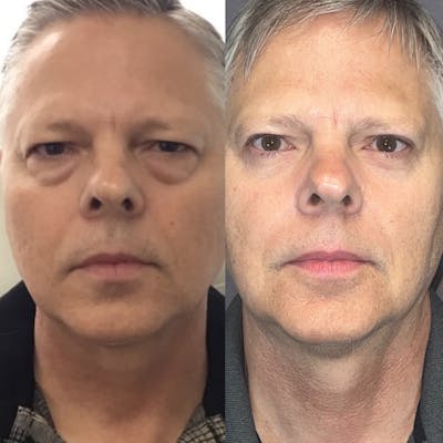 Lower Blepharoplasty Before & After Gallery - Patient 148271323 - Image 1