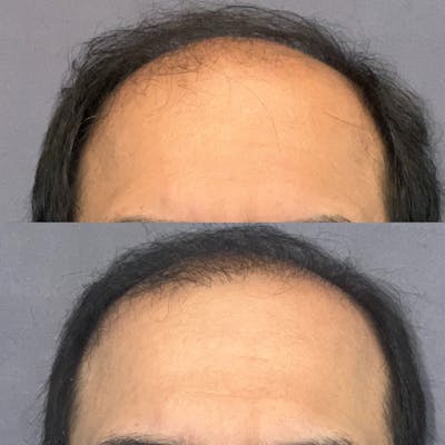 Hair Restoration  Before & After Gallery - Patient 149096849 - Image 1