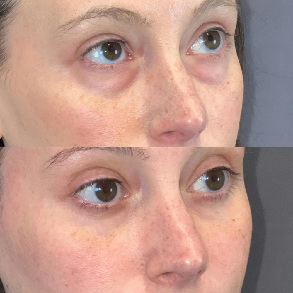 Lower Blepharoplasty Before & After Gallery - Patient 149191436 - Image 3