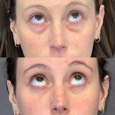 Lower Blepharoplasty Before & After Gallery - Patient 149191436 - Image 2