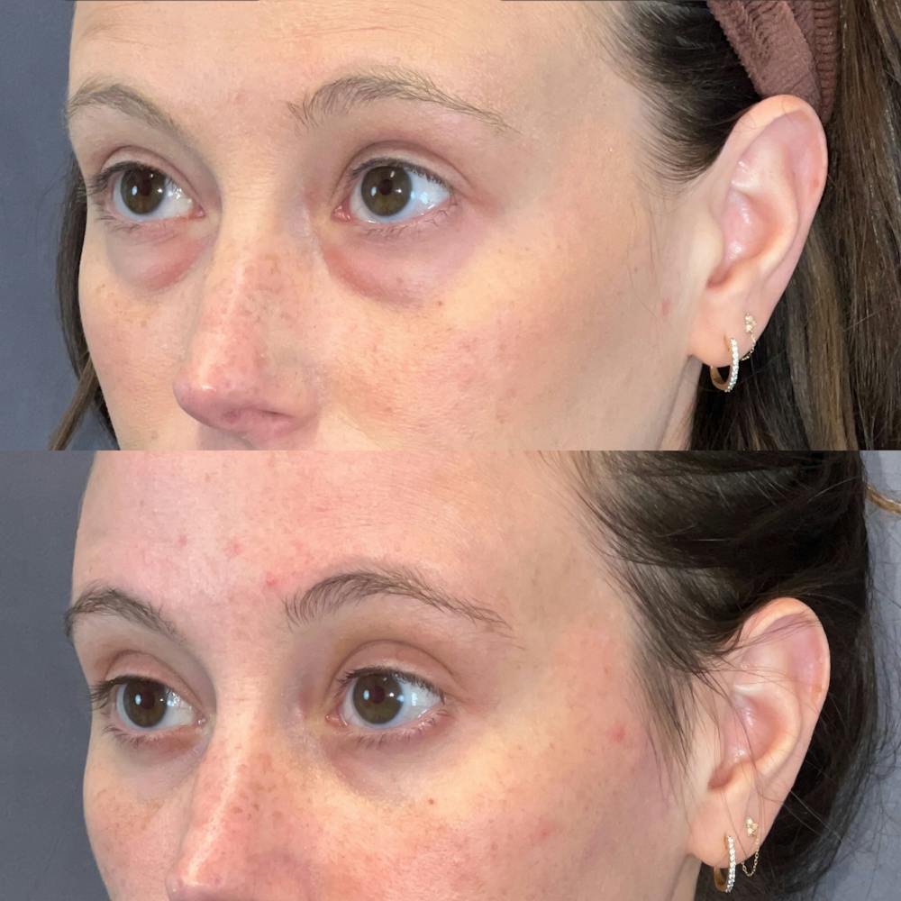 Lower Blepharoplasty Before & After Gallery - Patient 149191436 - Image 4