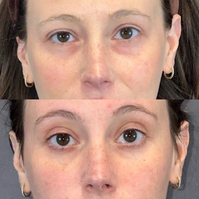 Lower Blepharoplasty Before & After Gallery - Patient 149191436 - Image 1