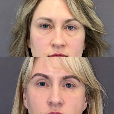 Lower Blepharoplasty Before & After Gallery - Patient 149191616 - Image 1