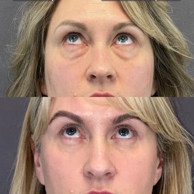 Lower Blepharoplasty Before & After Gallery - Patient 149191616 - Image 2