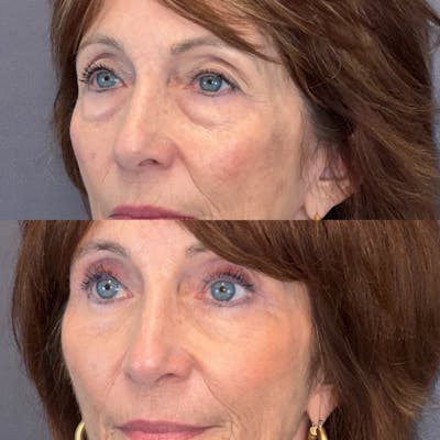 Lower Blepharoplasty Before & After Gallery - Patient 149257993 - Image 2
