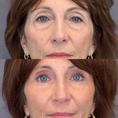 Lower Blepharoplasty Before & After Gallery - Patient 149257993 - Image 1