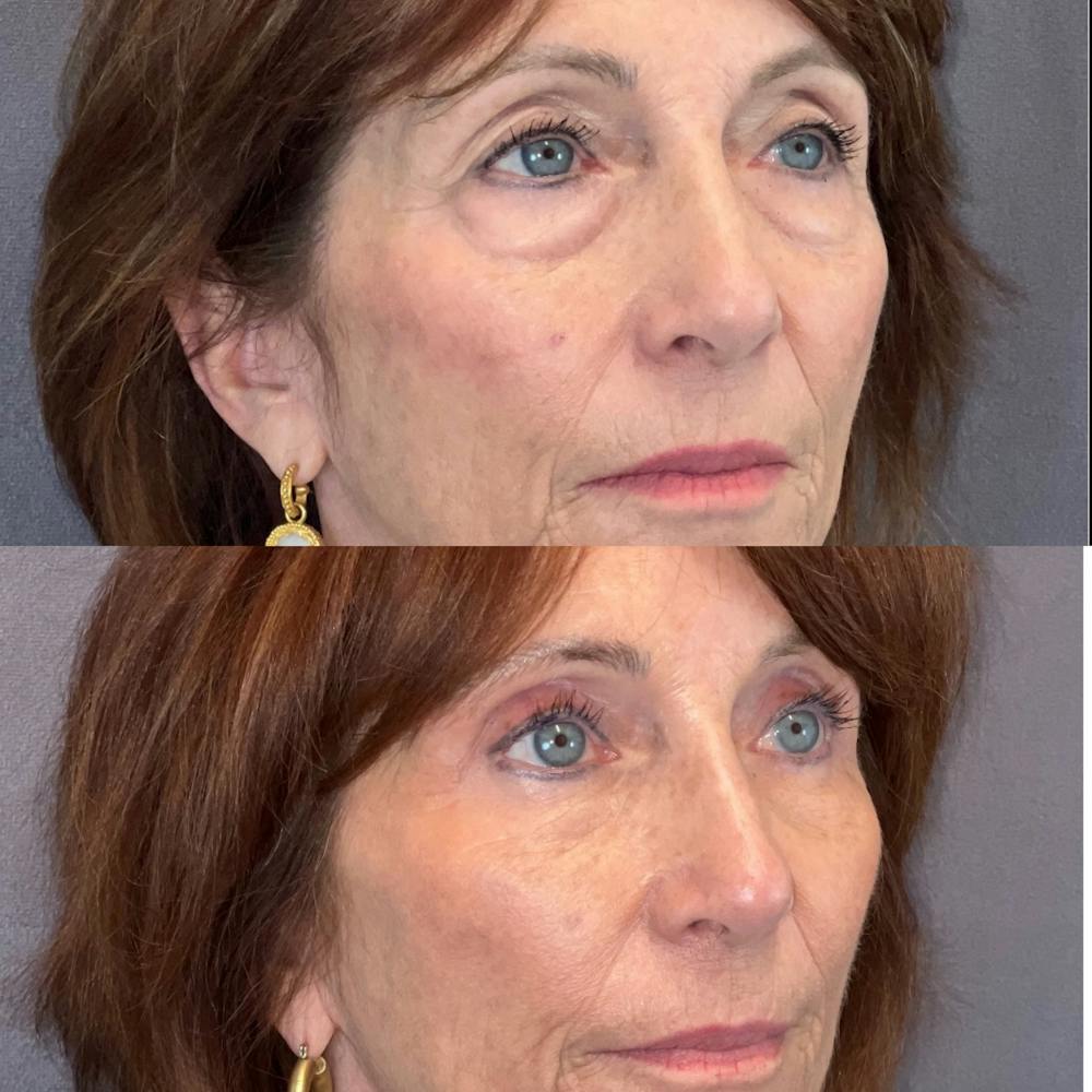 Lower Blepharoplasty Before & After Gallery - Patient 149257993 - Image 3