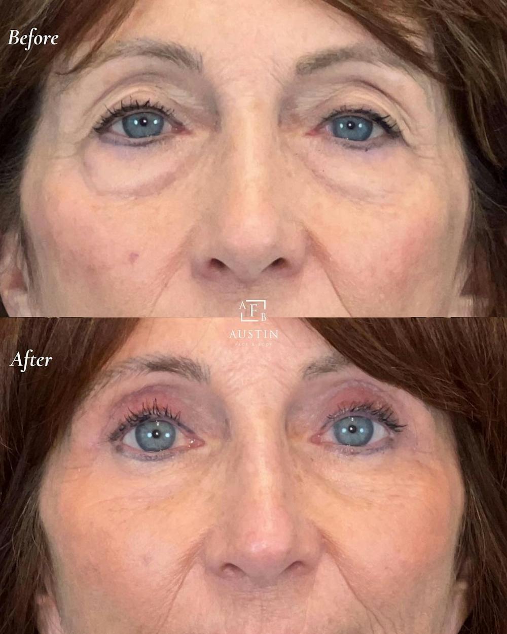 Upper Blepharoplasty Before & After Gallery - Patient 149257988 - Image 1
