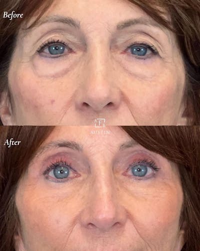 Upper Blepharoplasty Before & After Gallery - Patient 149257988 - Image 1