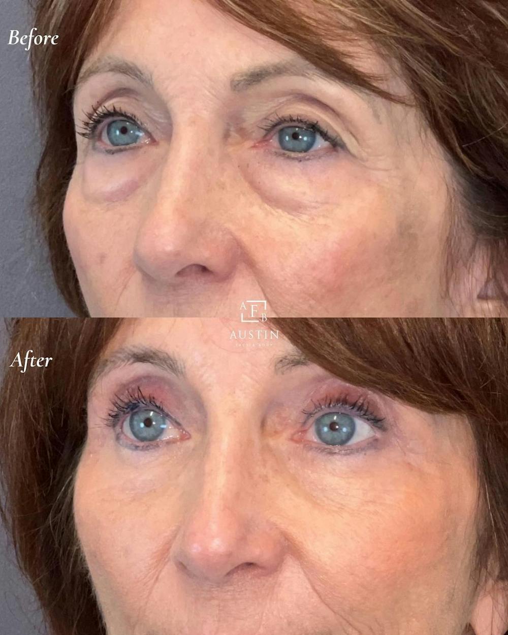 Upper Blepharoplasty Before & After Gallery - Patient 149257988 - Image 2